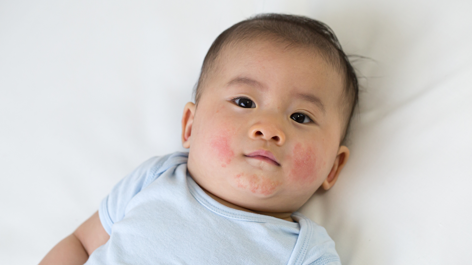 Understanding Eczema in Babies and Children: FAQs Answered